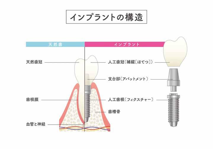 インプラントの構造について